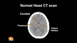 Normal Head CT Scan Anatomy Made Simple Neuroradiology [upl. by Garcon]