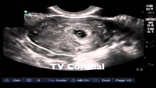 Introduction to pelvic ultrasonography [upl. by Ramso]