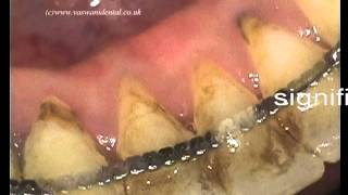 Non Surgical Periodontal Treatment [upl. by Mayhs]