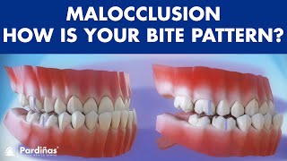 Malocclusion  Bite patterns © [upl. by Elirpa341]