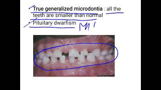 Microdontia [upl. by Silvestro]