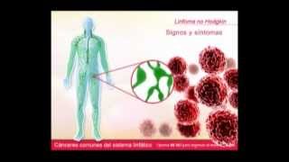 Canceres Comunes del Sistema Linfatico [upl. by Eiznyl]