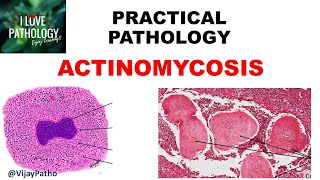 Practical Pathology ACTINOMYCOSIS [upl. by Aihsenyt]