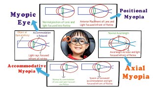 Myopia  Introduction and Etiology within 3 min 15 [upl. by Farant]