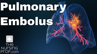 Pulmonary Embolus Nursing Care [upl. by Nairolf]