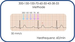 EKGBefundung Herzfrequenz in Sekunden bestimmen 300150100Methode [upl. by Aroel]