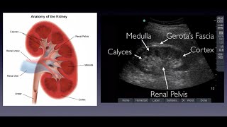 Introduction to Renal Ultrasound [upl. by Guntar]