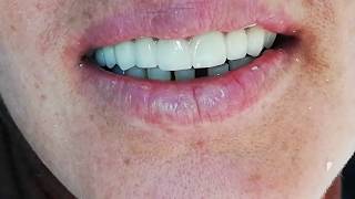 Zirconia Full Mouth Upper Dental Bridge [upl. by Marybeth378]