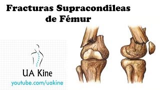 Fracturas Supracondileas de Fémur Tratamiento [upl. by Hsiwhem]