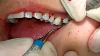 Gracey Instrumentation During Periodontal Therapy [upl. by Arquit154]