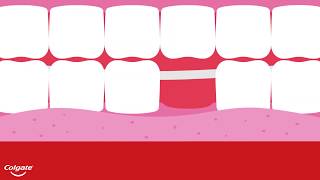 The Four Types of Dental Bridges [upl. by Ebonee]