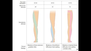 Lumbosacral radiculopathy [upl. by Marcus]