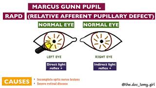 Abnormal Pupillary Reflexes  Ophthalmology [upl. by Niar]