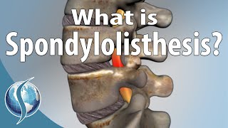 What Is Spondylolisthesis [upl. by Chapen498]