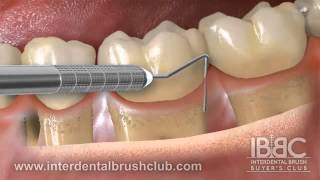 Periodontal disease causes and treatment [upl. by Aspasia]