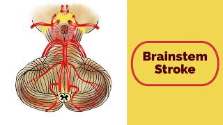 Brainstem Stroke Syndromes [upl. by Bear]