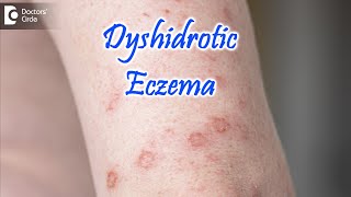 Dyshidrotic Eczema  POMPHOLYX   Causes Symptoms amp Treatment  Dr Nischal K  Doctors Circle [upl. by Sidoney]