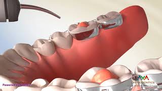 Posterior Bite Block  Orthodontic Treatment [upl. by Gambrell]