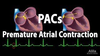 Premature Atrial Contractions PACs Animation [upl. by Proulx]