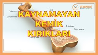 KAYNAMAYAN KEMİK KIRIKLARININ TEDAVİSİ [upl. by Adlemy559]