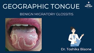 Geographic tongue  Benign migratory glossitis [upl. by Yrod631]