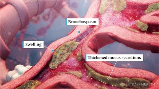 Difference Between Asthma and Bronchitis [upl. by Home440]