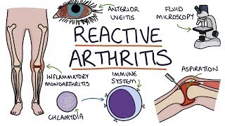 Understanding Reactive Arthritis [upl. by Rabin]