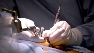 Spinal Decompression Surgery  Explained by Dr Kevin Ju [upl. by Ynnaj]