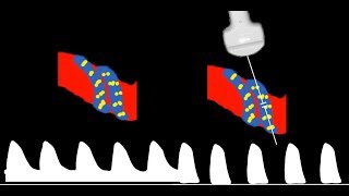 Umbilical Artery Doppler interpretation [upl. by Gnen884]