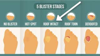 How To Treat A Blister Correctly First Look At Your Blister Roof [upl. by Elise]