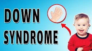 Down Syndrome Features [upl. by Varipapa]