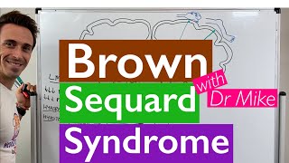 Brown Sequard Syndrome [upl. by Sharona]