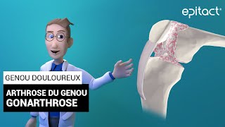 Gonarthrose  Arthrose du genou  Explications – EPITACT [upl. by Accem]