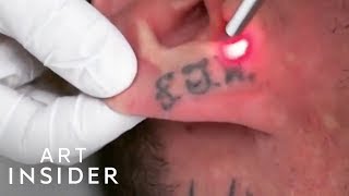 How Tattoo Removal Works [upl. by Libb257]