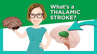 Thalamic Stroke [upl. by Stichter]