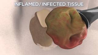 Dental Cyst and Infection Causes Symptoms Types and Treatment [upl. by Slinkman]