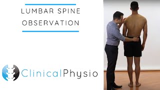 Lumbar Spine Observation  Clinical Physio [upl. by Harmon]