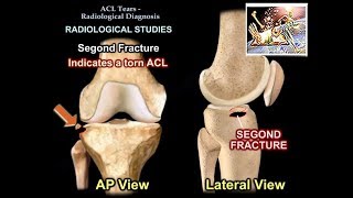 ACL Tears Radiological Evaluation  Everything You Need To Know  Dr Nabil Ebraheim [upl. by Aiyot161]