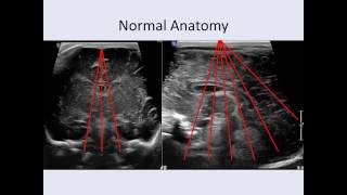 Cranial Ultrasound Anatomy [upl. by Seaton]