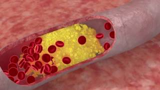 DISLIPIDEMIA ¿Qué es [upl. by Eentruoc]