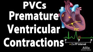 Premature Ventricular Contractions PVCs Animation [upl. by Mariann]