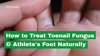 Athletes Foot Fungus BEST Home Remedies amp Treatment [upl. by Clotilda]