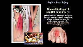 Sagittal Band Injury  Everything You Need To Know  Dr Nabil Ebraheim [upl. by Nywde]