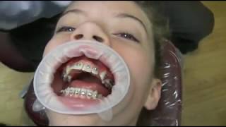 Watch how we put your braces on [upl. by Emmalee]