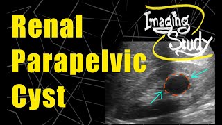 Renal Parapelvic Cyst  Bosniak GradeI  Ultrasound  Case 83 [upl. by Ehud816]