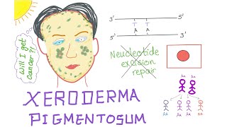 Xeroderma Pigmentosum [upl. by Enilarak]