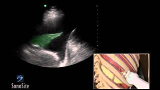 How To Ultrasound Guided Thoracentesis Exam 3D Video [upl. by Cuttler]