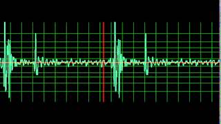 Normal Heart Sound normal speed [upl. by Annauqal75]