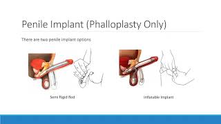 Phalloplasty Exploring Your Options [upl. by Adham344]