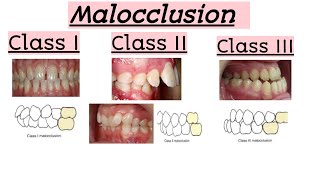 malocclusionsClass IClass IIClass IIIClinical featuresQuick Revision [upl. by Nylanaj]